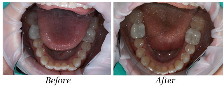 Before and After Adult Ortho Cedar Rapids, IA