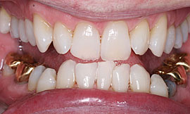 After Teeth Whitening Cedar Rapids Example 1
