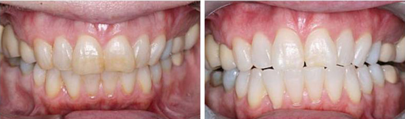  Tooth Whitening Example 1 Cedar Rapids, IA