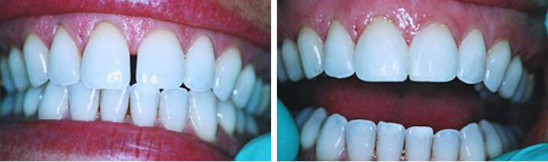  Tooth Bonding Example 3 Cedar Rapids, IA