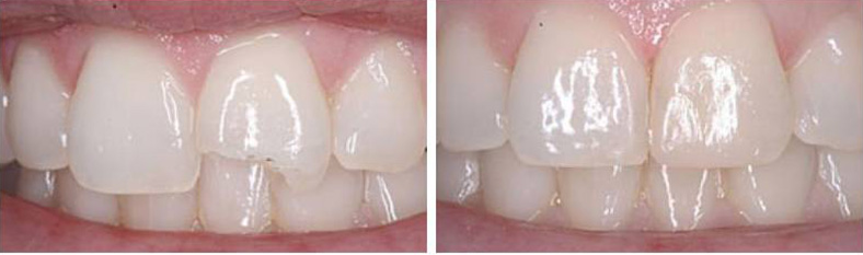  Tooth Bonding Example 1 Cedar Rapids, IA
