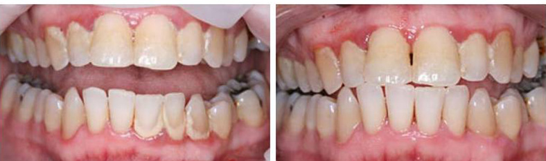  Periodontal Disease: Scaling and Root Planing Cedar Rapids, IA