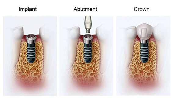Dental Implants Cedar Rapids, IA